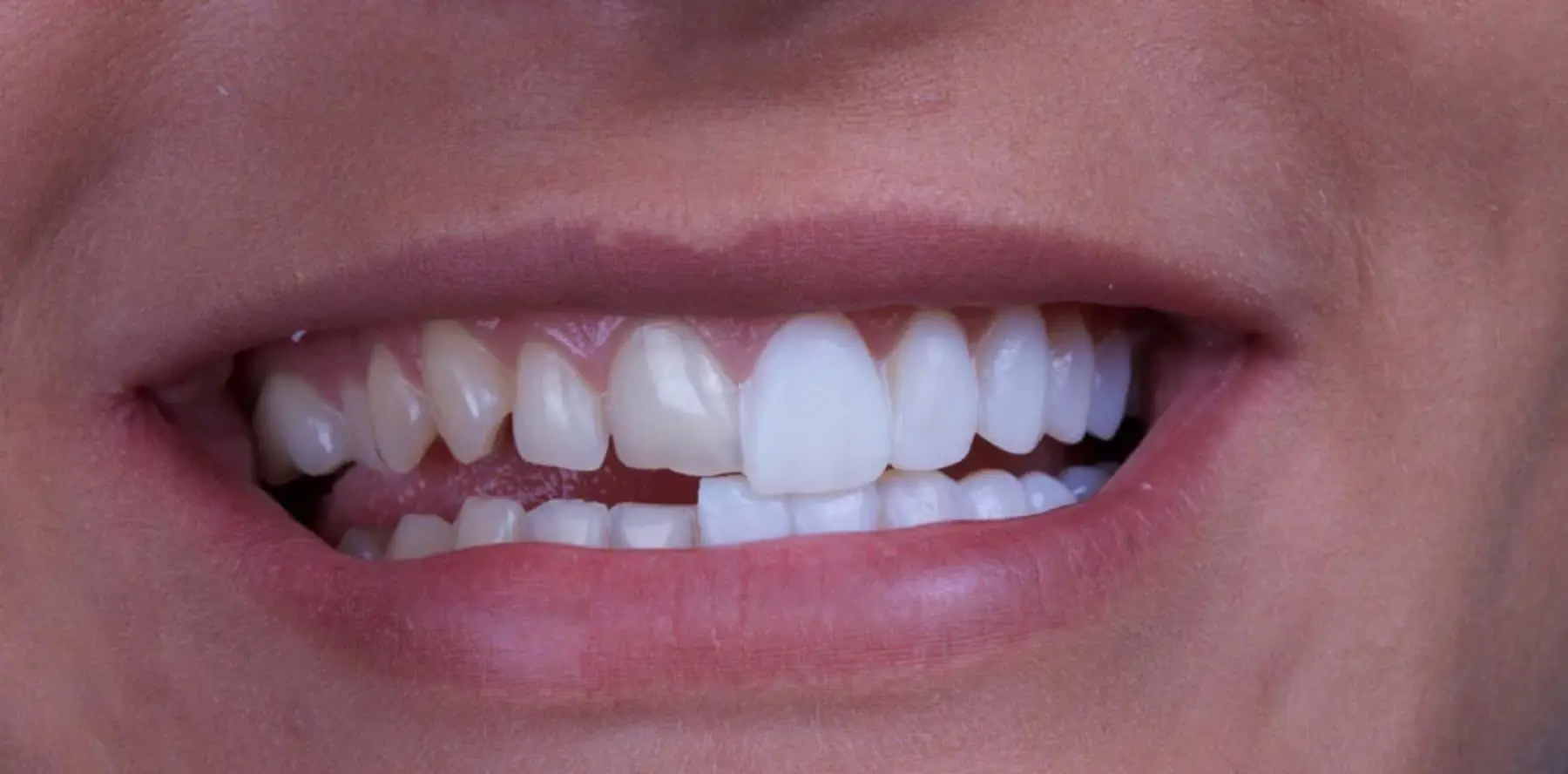 Porcelain dental crowns placed on the front teeth