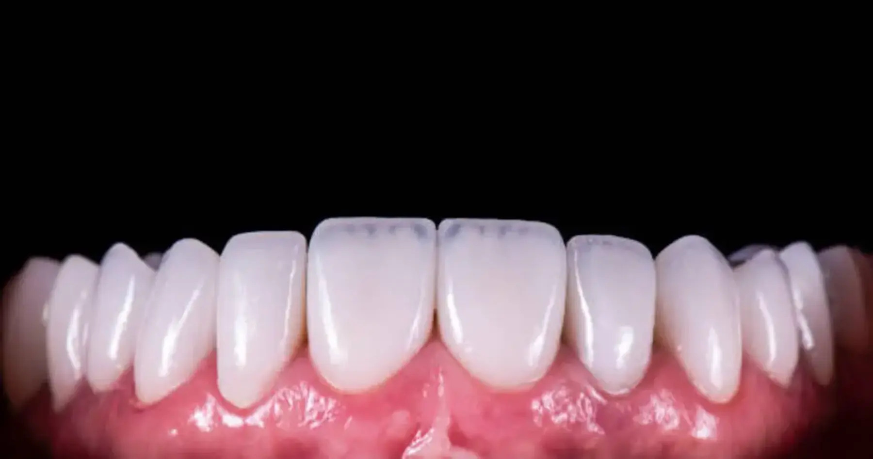 Preparing a tooth and trying in a porcelain crown