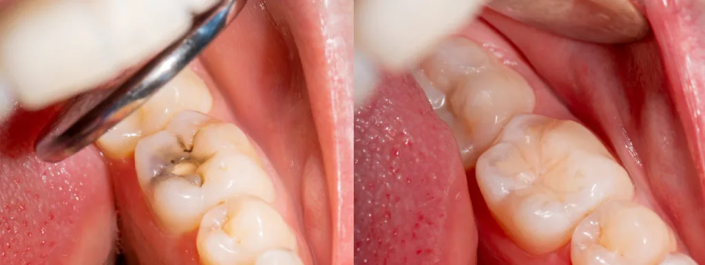 methods used in restorative dental treatment