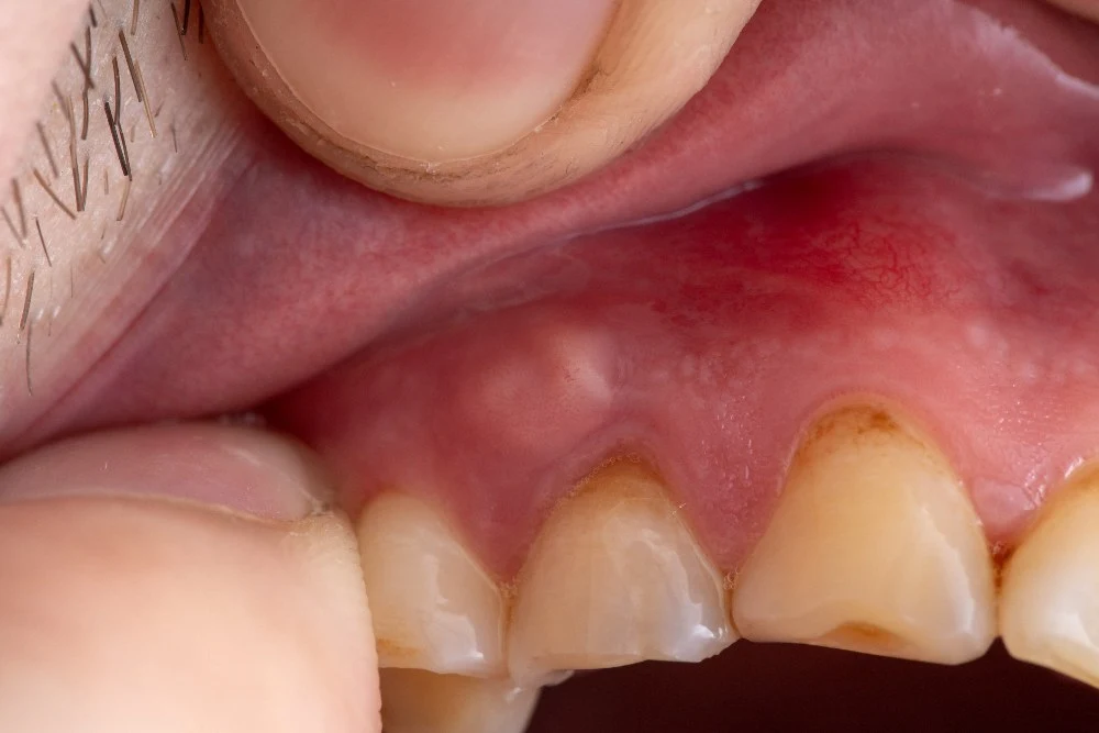 Dental examination of a tooth abscess and root-tip infection