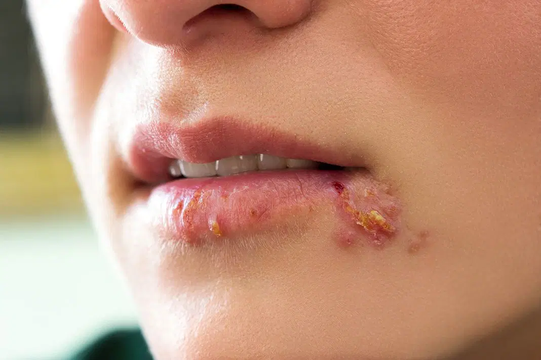 Crusted cold sore lesion on the edge of the lower lip