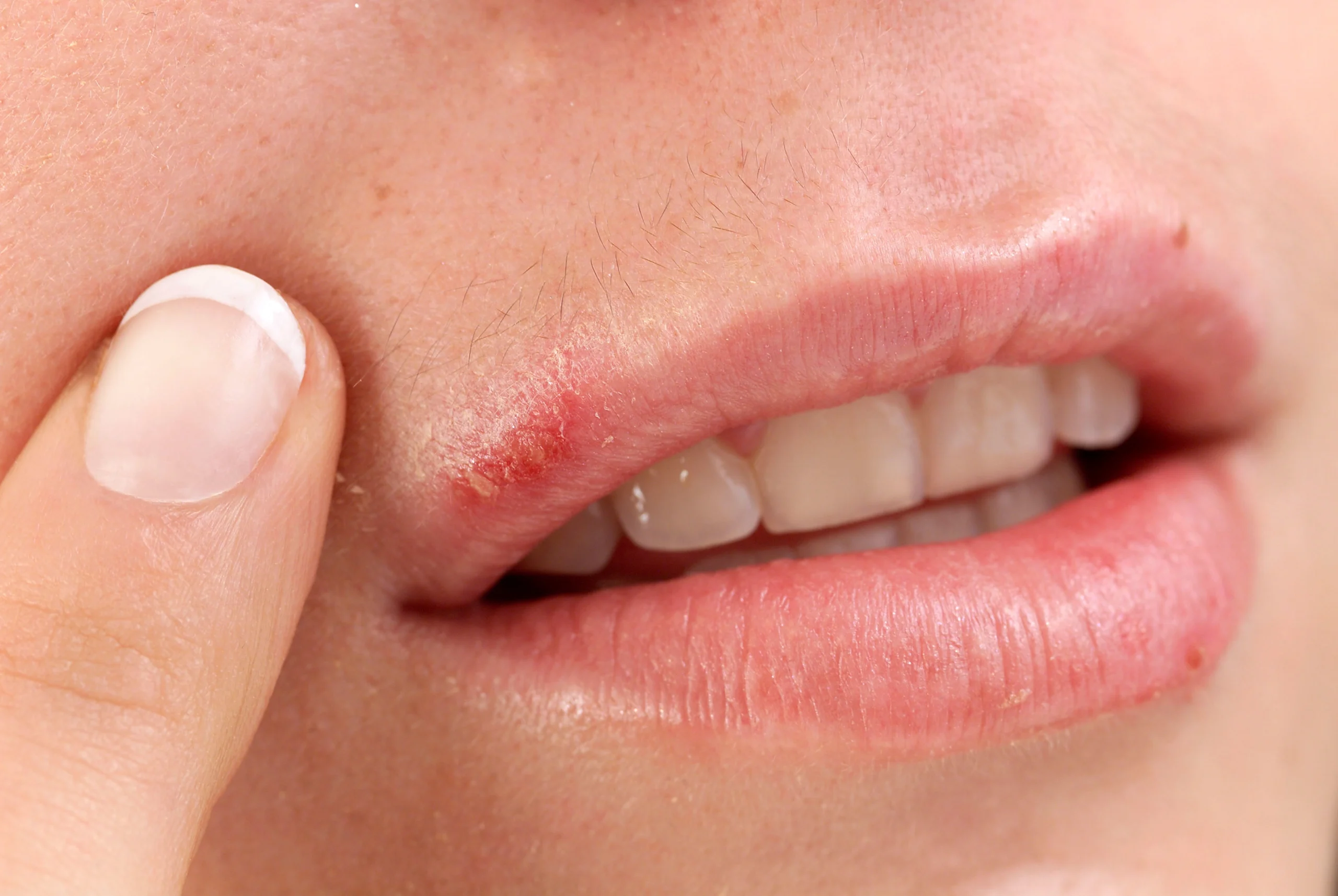 Cold sore on the upper lip edge with redness and crusting