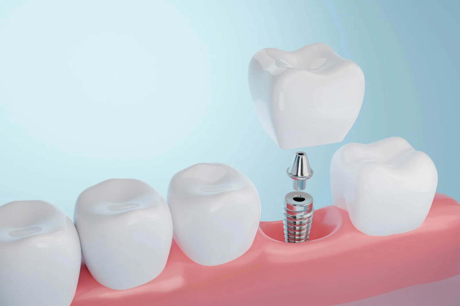 Diagram of an implant-supported crown in a jaw with a missing tooth