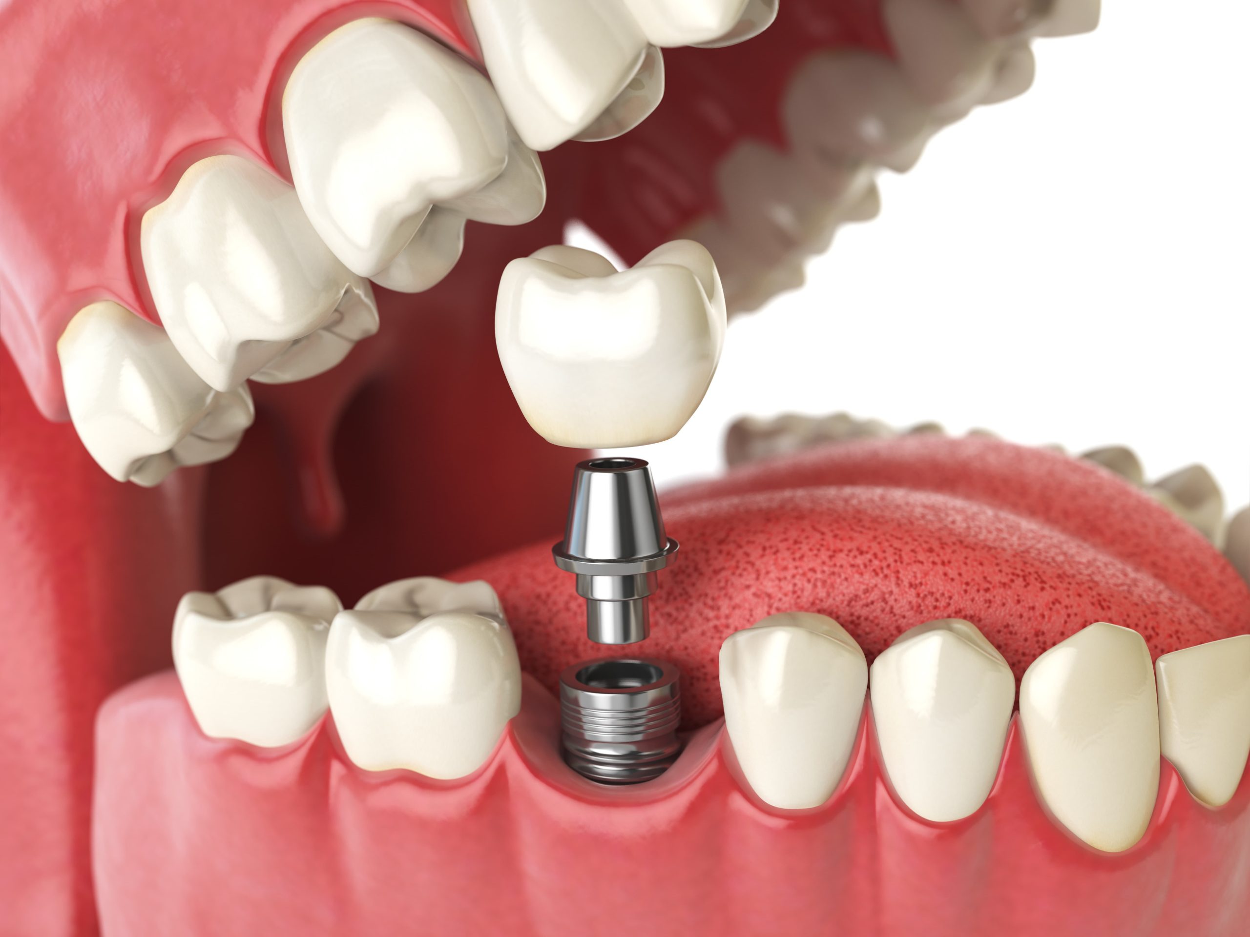 Three-dimensional model showing the placement of an implant, abutment and crown