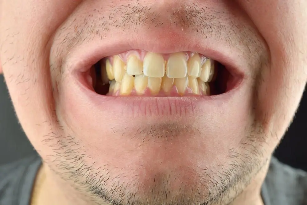 Factors that cause yellow teeth, such as tea, coffee and tobacco