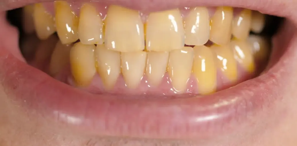 Close-up view of yellowed teeth