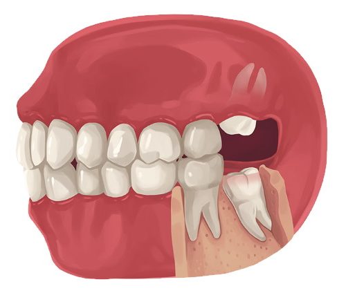 Illustration showing impacted wisdom teeth in the upper and lower jaw