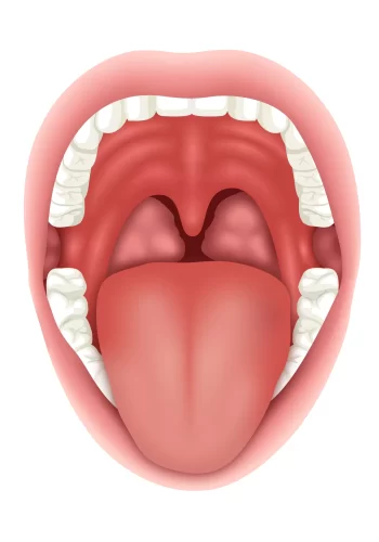 View inside the mouth showing the different types of mouth sores