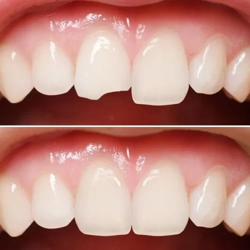 Care after bonding: cleaning teeth with a soft toothbrush