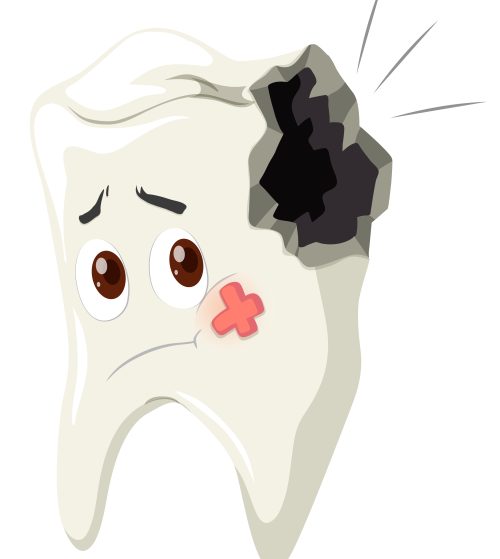 Why teeth decay: acid production by plaque bacteria and loss of enamel