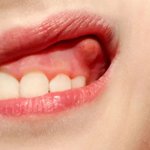 A gum abscess appearing as a pimple-like bump on the gum