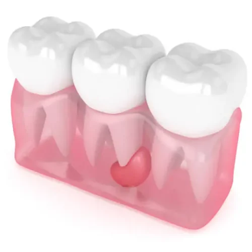 signs of infection after wisdom tooth extraction