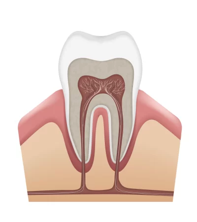 plaque and tartar building up along the gum line, the main cause of inflammation