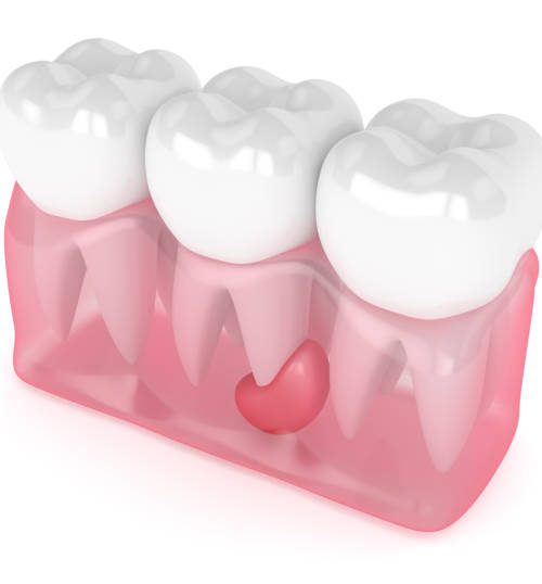 How a gum cyst forms and its link to tooth root infection