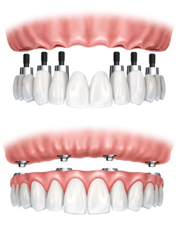 Examples of removable and fixed dental prostheses