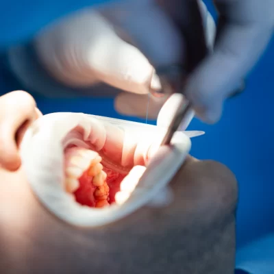 Cleaning the root canals during endodontic treatment