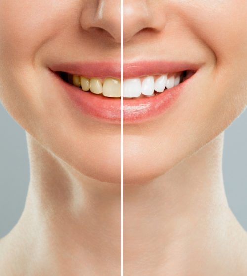 Smile design and a natural smile