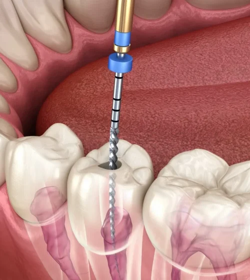 how root canal treatment is done