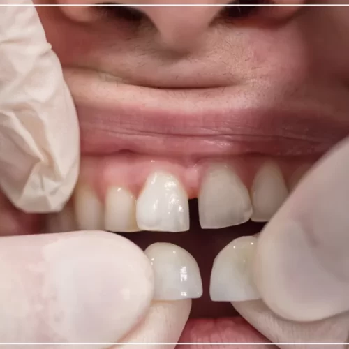 Composite veneer being shaped at the dental clinic
