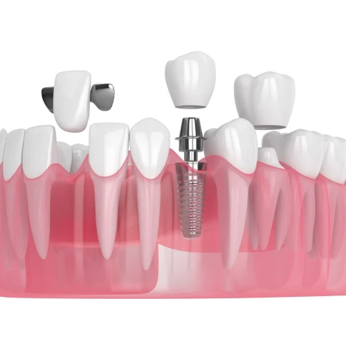 Traditional, adhesive and implant-supported dental bridge types