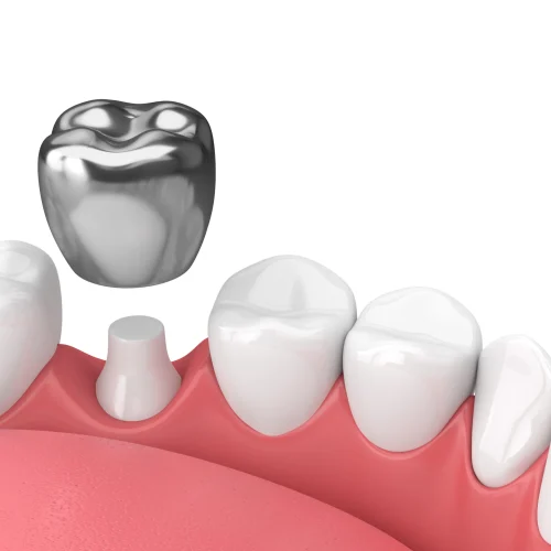 Crown treatment for a broken tooth