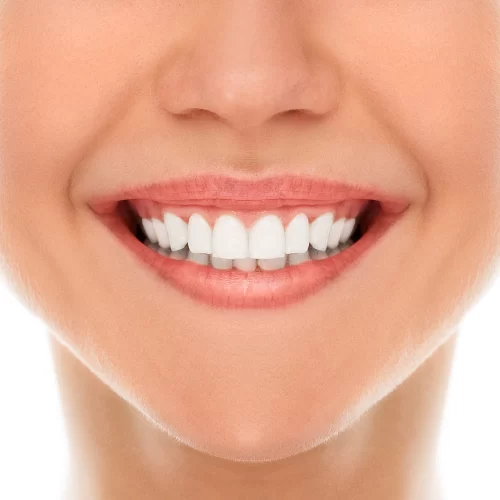 Leaf porcelain veneer made in the dental laboratory
