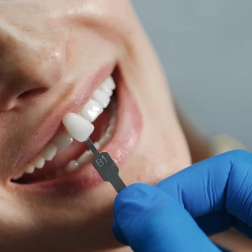 The difference between a zirconia restoration and a veneer