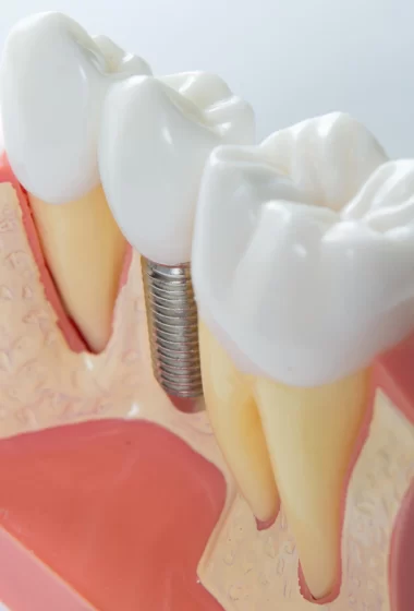 dental-implant dental-implant