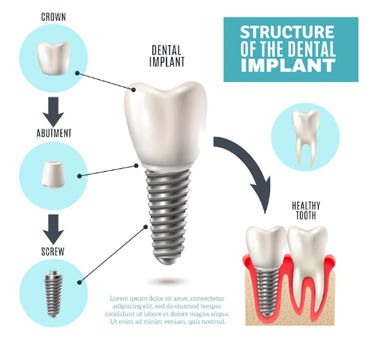 dental-implants-procedure