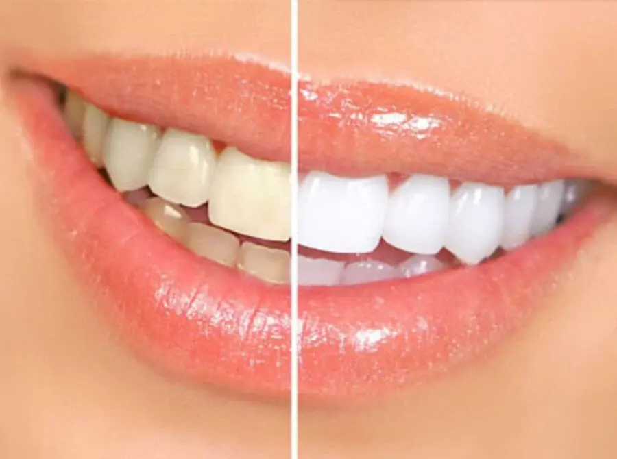 cosmetic-dentistry-before-after