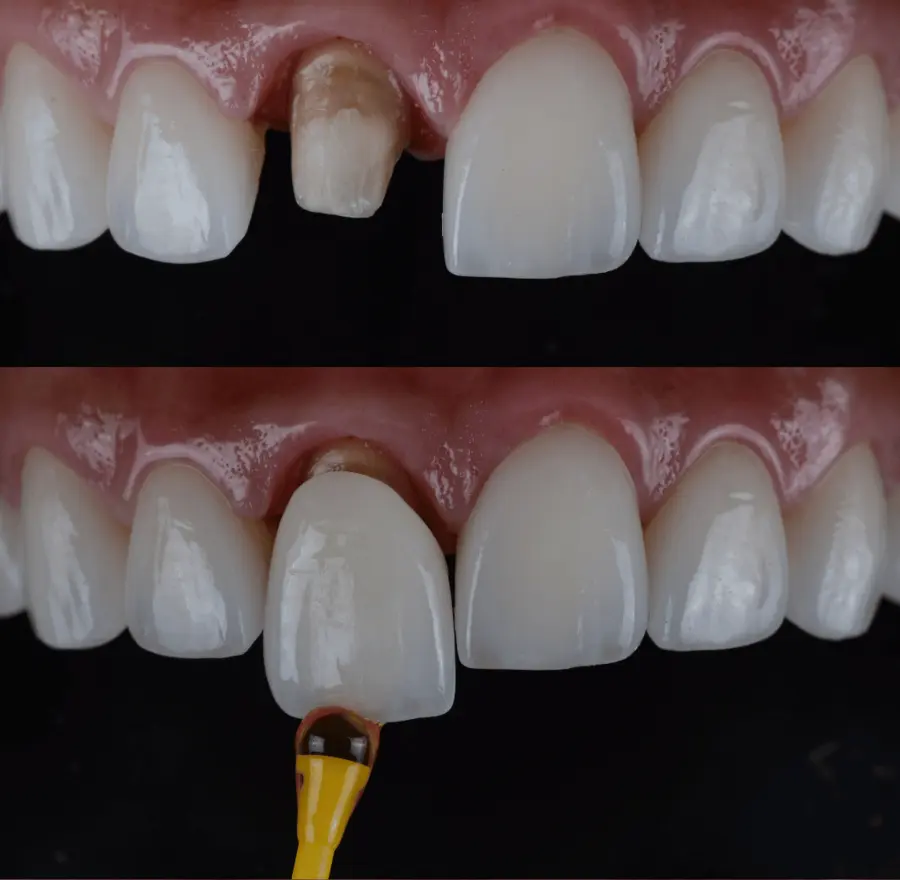 dental-crown-how
