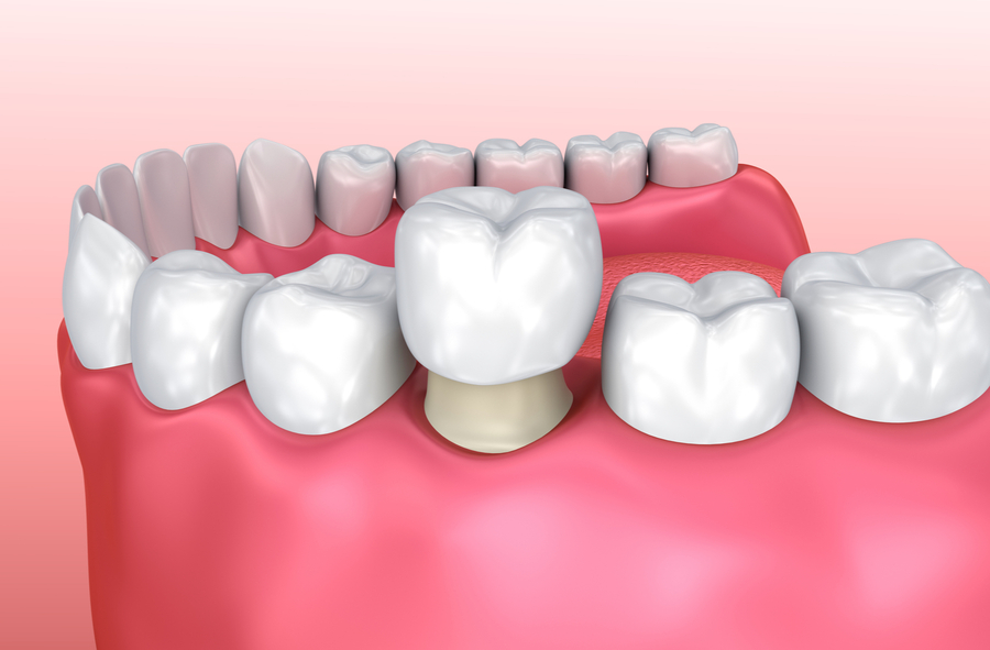 dental-crown-model