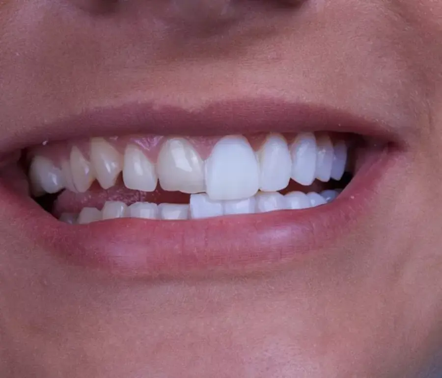 dental-veneers-example