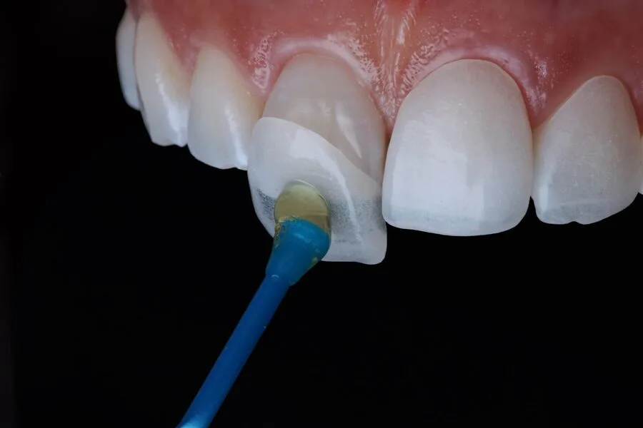 dental-veneers-how