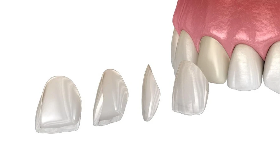 dental-veneers-model