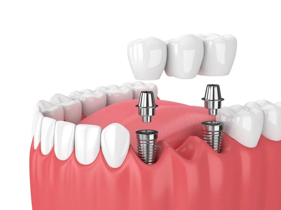 restorative-dentistry-model restorative dentistry model