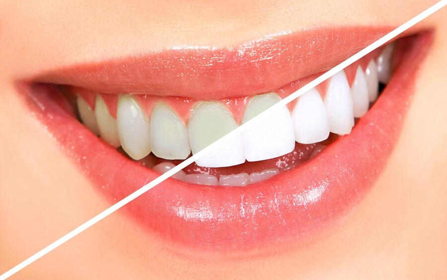 tooth-whitening-before-after